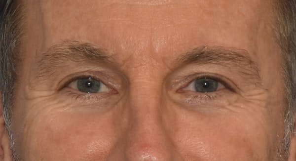Brow Lift Before & After Gallery - Patient 734324 - Image 2