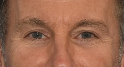 Eyelid Lift Before & After Gallery - Patient 241917 - Image 2