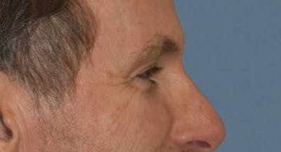 Brow Lift Before & After Gallery - Patient 734324 - Image 6