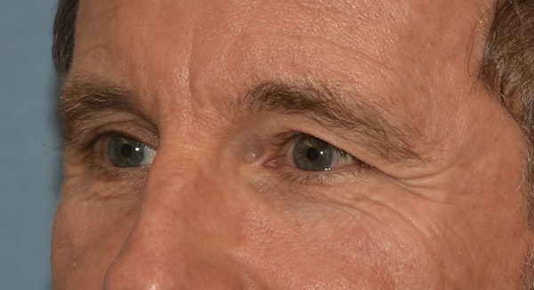 Brow Lift Before & After Gallery - Patient 734324 - Image 7