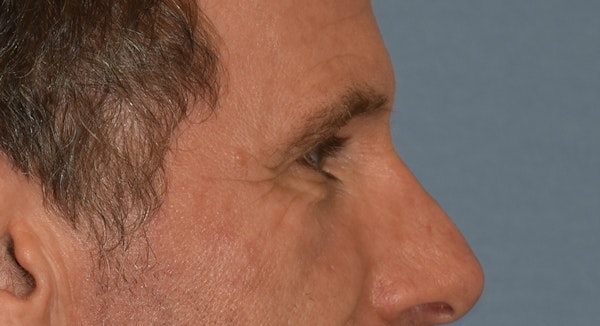 Brow Lift Before & After Gallery - Patient 734324 - Image 5