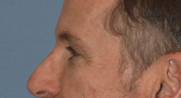 Brow Lift Before & After Gallery - Patient 734324 - Image 10