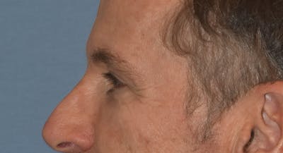 Brow Lift Before & After Gallery - Patient 734324 - Image 10