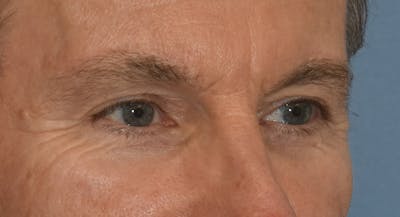 Brow Lift Before & After Gallery - Patient 734324 - Image 4