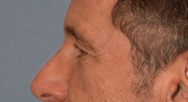Brow Lift Before & After Gallery - Patient 734324 - Image 9