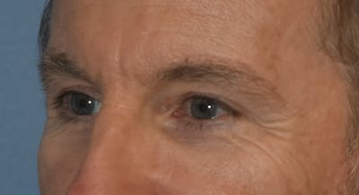 Brow Lift Before & After Gallery - Patient 734324 - Image 8