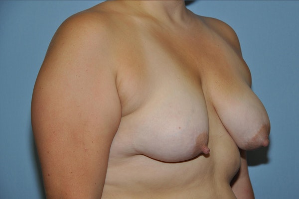 Breast Lift Before & After Gallery - Patient 267004 - Image 3
