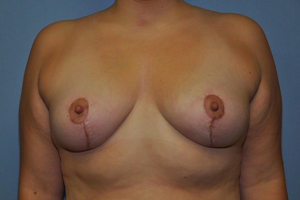 Breast Lift Before & After Gallery - Patient 267004 - Image 2