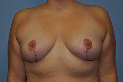 Breast Lift Before & After Gallery - Patient 267004 - Image 2