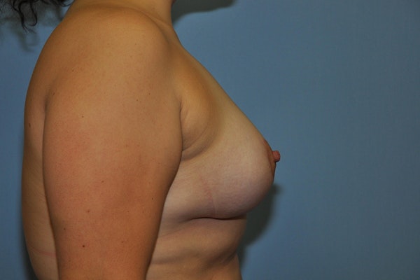 Breast Lift Before & After Gallery - Patient 267004 - Image 6