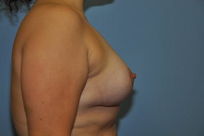 Breast Lift Before & After Gallery - Patient 267004 - Image 6