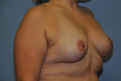 Breast Lift Before & After Gallery - Patient 267004 - Image 4