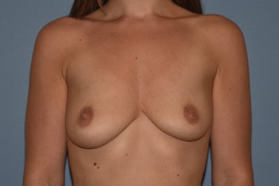 Breast Augmentation Lift Before & After Gallery - Patient 219825 - Image 1
