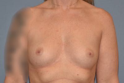 Breast Augmentation Before & After Gallery - Patient 181467 - Image 1