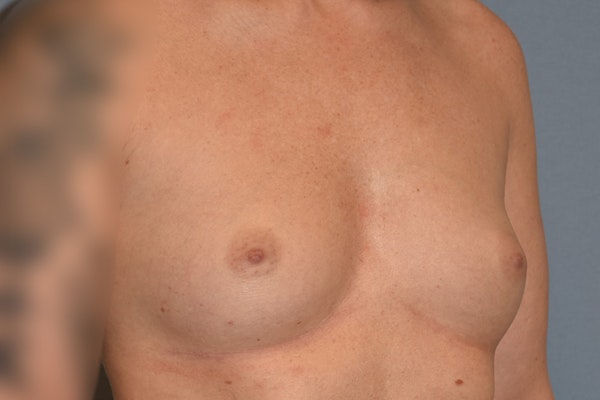 Breast Augmentation Before & After Gallery - Patient 181467 - Image 3