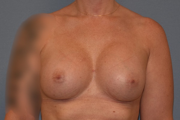 Breast Augmentation Before & After Gallery - Patient 181467 - Image 2
