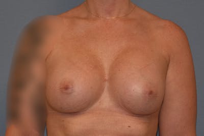 Breast Augmentation Before & After Gallery - Patient 181467 - Image 2