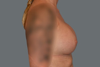 Breast Augmentation Before & After Gallery - Patient 181467 - Image 6