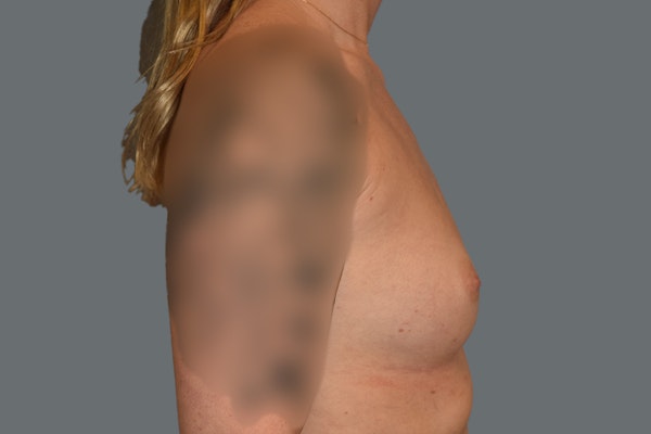 Breast Augmentation Before & After Gallery - Patient 181467 - Image 5