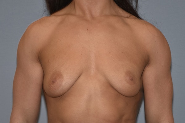 Breast Augmentation Lift Before & After Gallery - Patient 927116 - Image 1