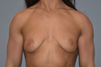 Breast Augmentation Lift Before & After Gallery - Patient 927116 - Image 1