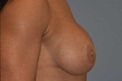 Breast Augmentation Lift Before & After Gallery - Patient 927116 - Image 6