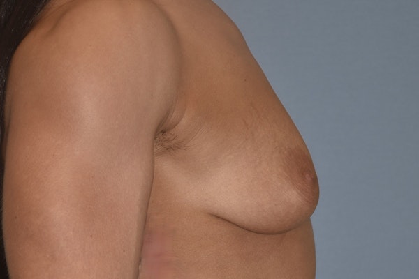 Breast Augmentation Lift Before & After Gallery - Patient 927116 - Image 5