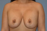 Breast Implant Removal Before & After Gallery - Patient 237620 - Image 1