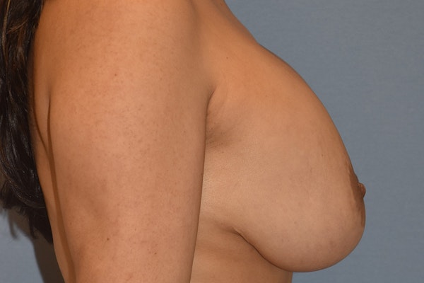 Breast Implant Removal Before & After Gallery - Patient 237620 - Image 5