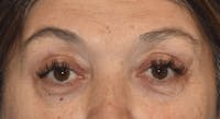 Eyelid Lift Before & After Gallery - Patient 860428 - Image 1