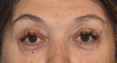 Eyelid Lift Before & After Gallery - Patient 860428 - Image 1