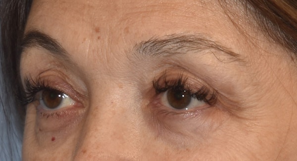 Eyelid Lift Before & After Gallery - Patient 860428 - Image 3