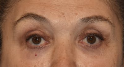 Eyelid Lift Before & After Gallery - Patient 860428 - Image 2