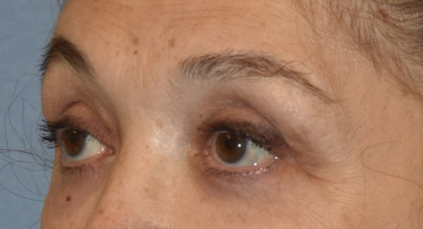 Eyelid Lift Before & After Gallery - Patient 860428 - Image 4