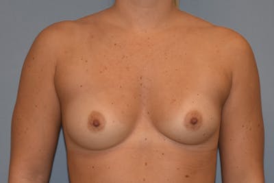 Breast Augmentation Before & After Gallery - Patient 255163 - Image 1