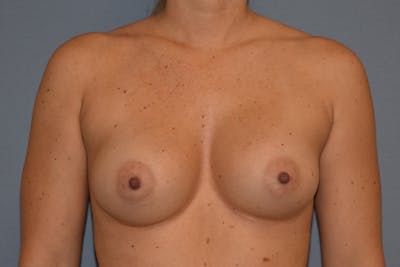 Breast Augmentation Before & After Gallery - Patient 255163 - Image 2