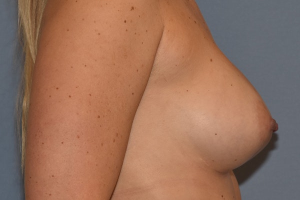 Breast Augmentation Before & After Gallery - Patient 255163 - Image 6