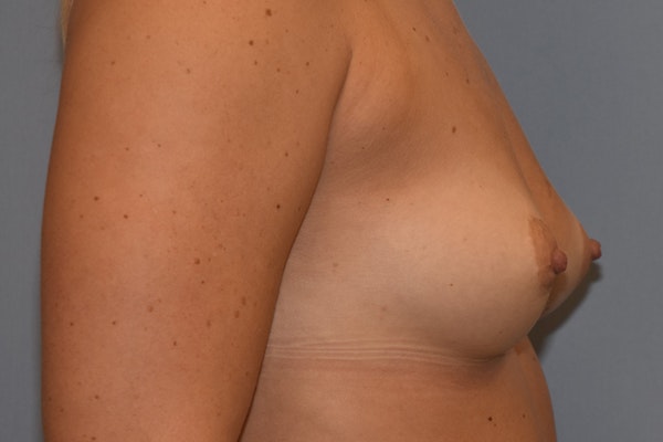 Breast Augmentation Before & After Gallery - Patient 255163 - Image 5