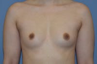 Breast Augmentation Before & After Gallery - Patient 378815 - Image 1