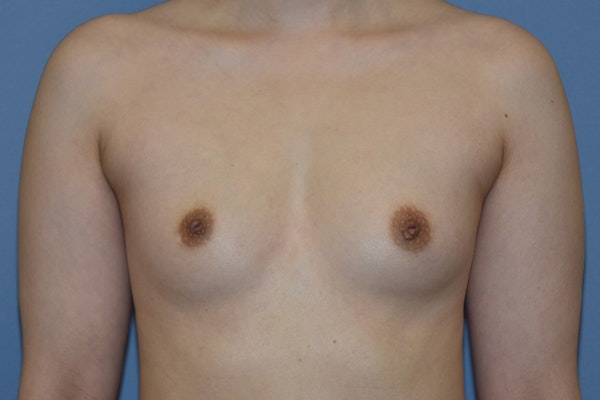 Breast Augmentation Before & After Gallery - Patient 378815 - Image 1