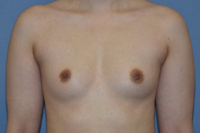 Breast Augmentation Before & After Gallery - Patient 378815 - Image 1