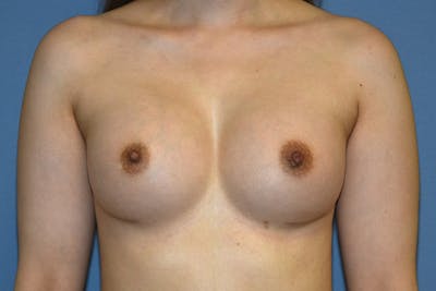 Breast Augmentation Before & After Gallery - Patient 378815 - Image 2