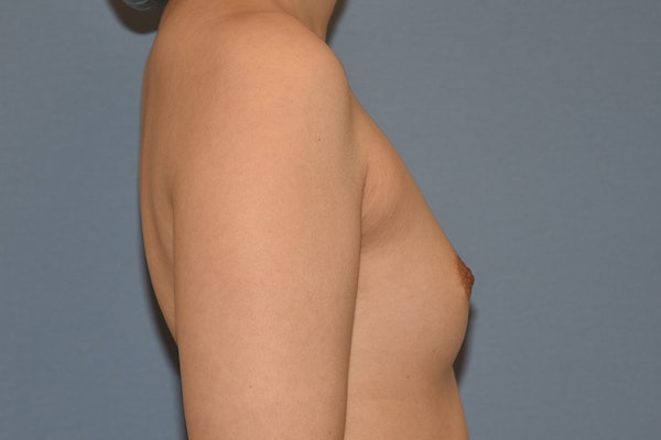 Breast Augmentation Before & After Gallery - Patient 378815 - Image 5