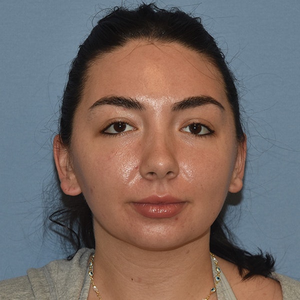 Submental Liposuction Before & After Gallery - Patient 143490 - Image 3
