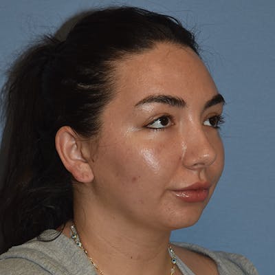Submental Liposuction Before & After Gallery - Patient 143490 - Image 1