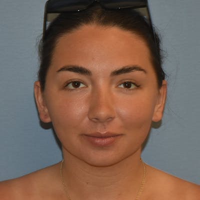 Submental Liposuction Before & After Gallery - Patient 143490 - Image 4