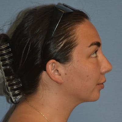 Submental Liposuction Before & After Gallery - Patient 143490 - Image 6