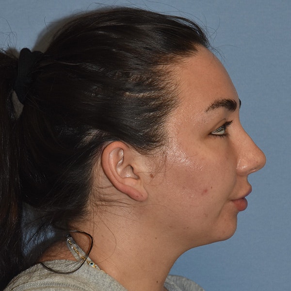 Submental Liposuction Before & After Gallery - Patient 143490 - Image 5