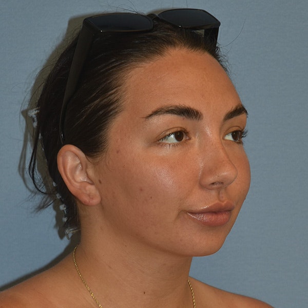Submental Liposuction Before & After Gallery - Patient 143490 - Image 2