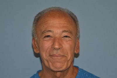 Otoplasty Before & After Gallery - Patient 132611 - Image 2